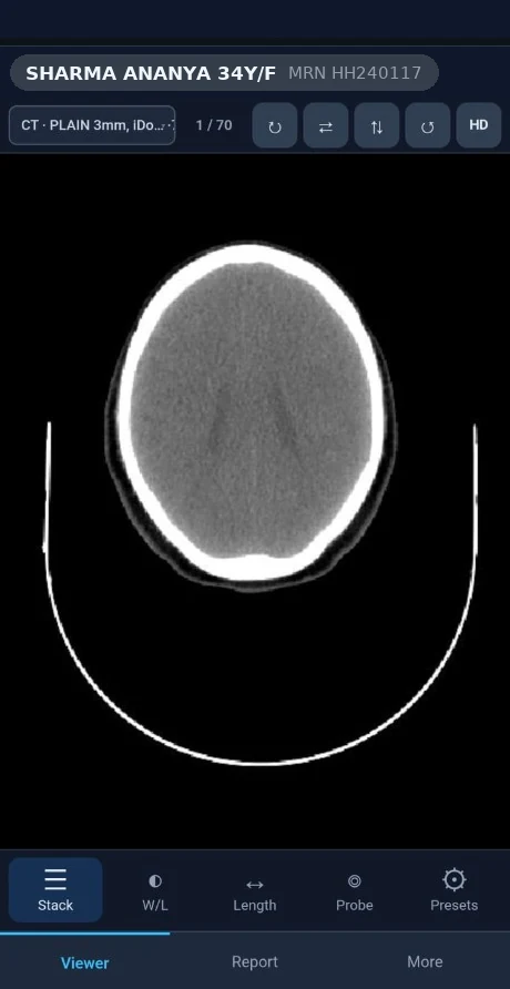 HEEBA mobile viewer with MRI study